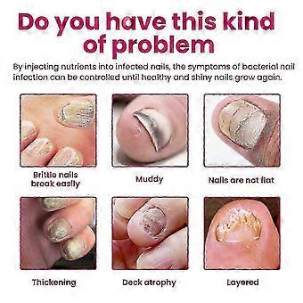 Ginger Nail Treatment 1pcs, Nail Fungus Removal Toenail Strengthening Essence for Cracked Surface Smoothing and Weak Brittle Nails