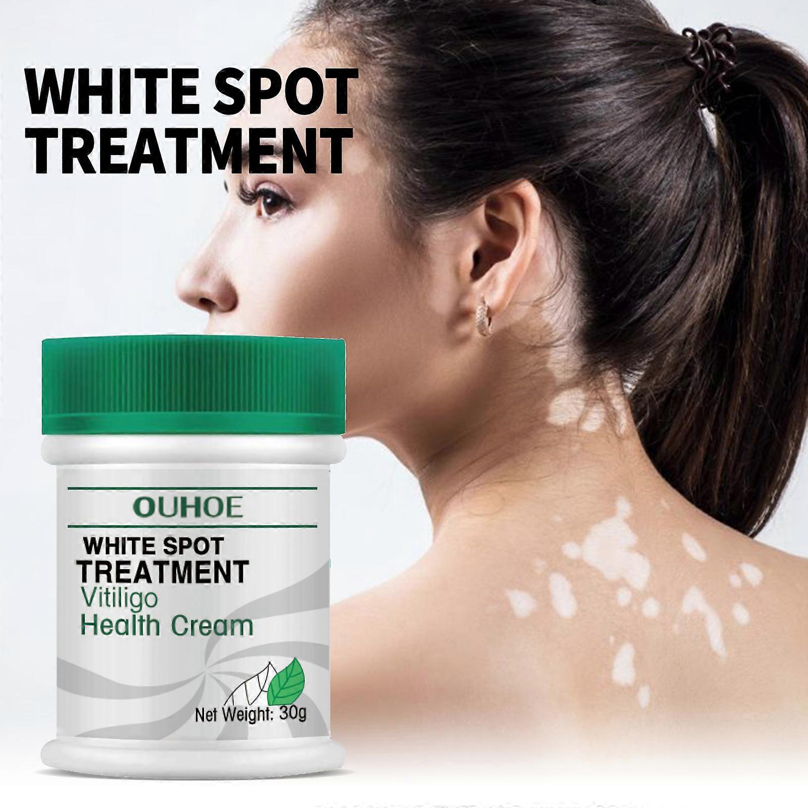 Vitiligo Treatment Ointment with Eliminate Pigmentation Comfrey Anti-bacterial Reduces White Spots On Skin