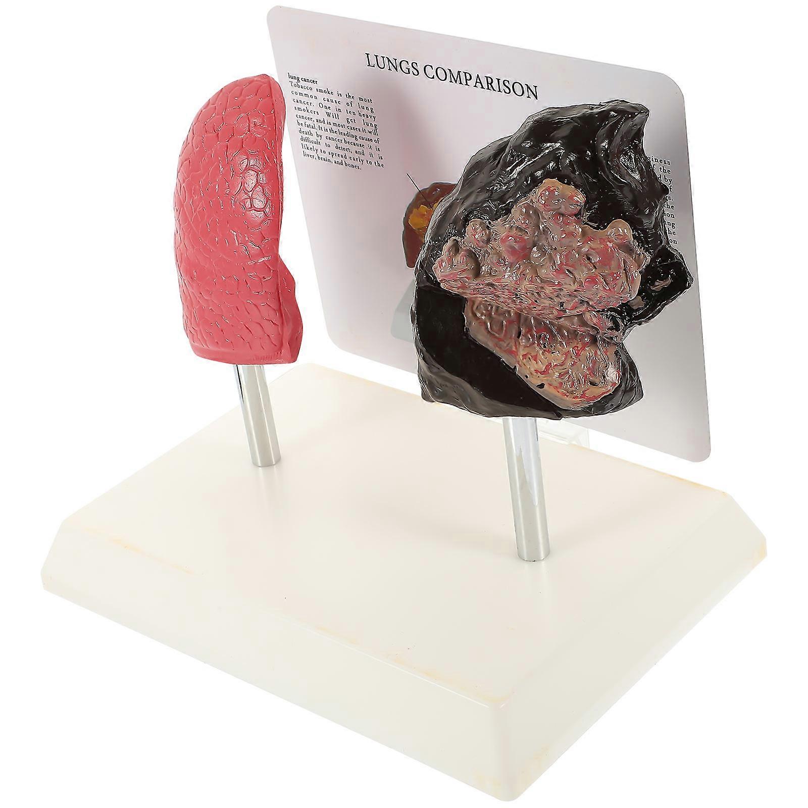 1 Pc Smoking Lung vs Normal Lung Comparison Model for Medical Teaching
