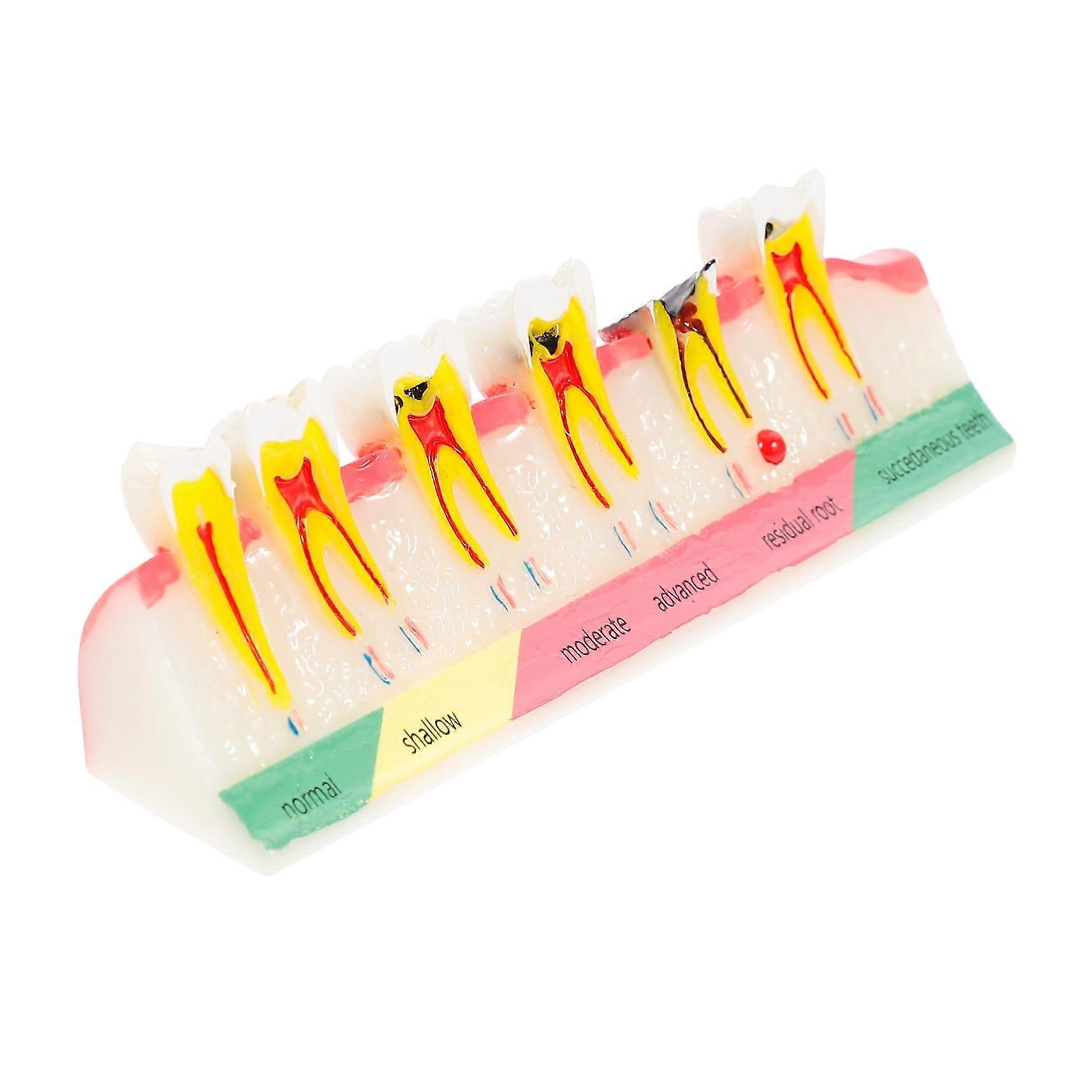 Dental Teaching Model with Realistic Tooth Decay Features for Classroom and Patient Education