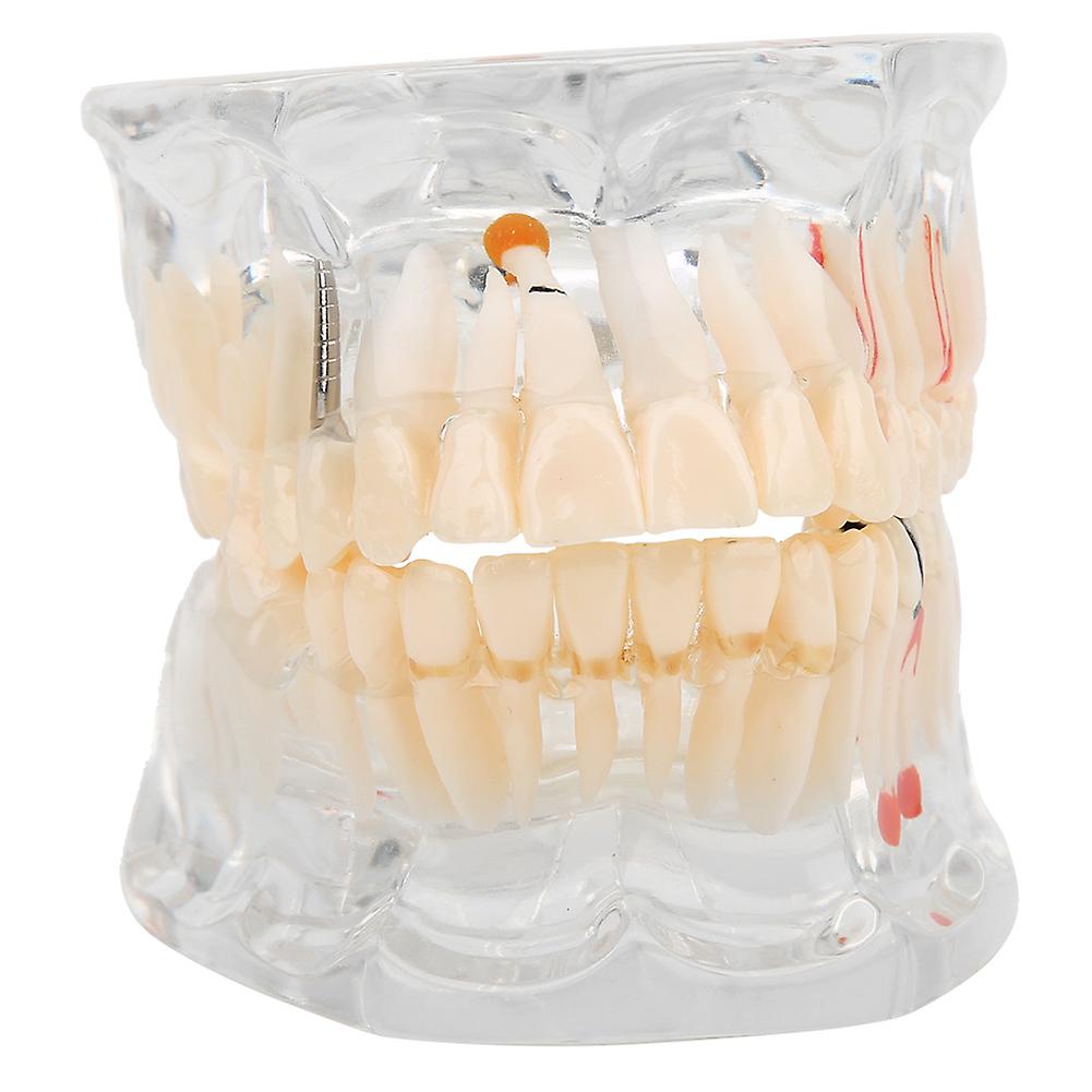 Pathology Model with Missing Tooth Dental Experimental Research Teaching Equipment