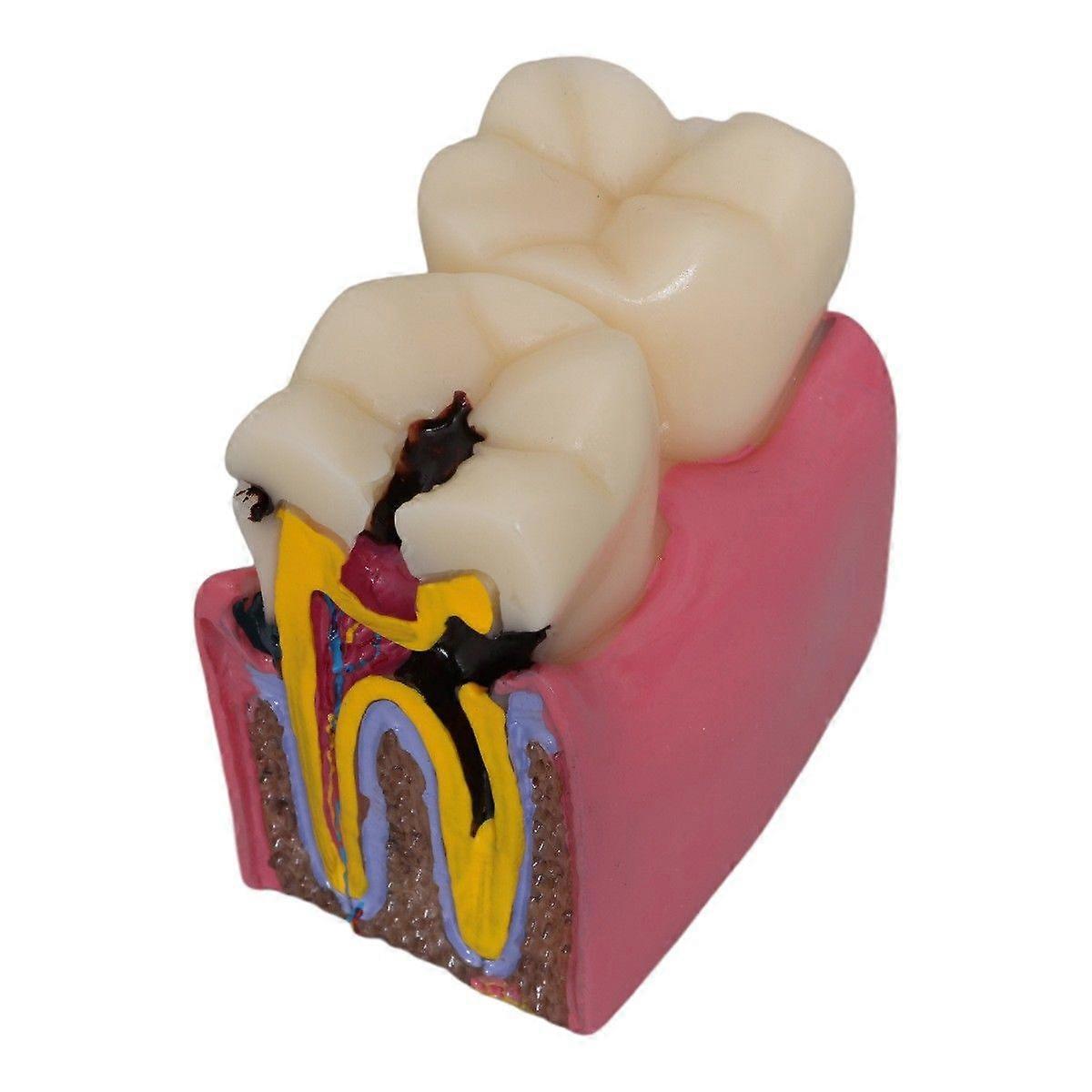 Caries Tooth Teaching Model: Decay Teeth Comparative Study Model Caries Bilateral Learning Teaching Tools for Patient Education