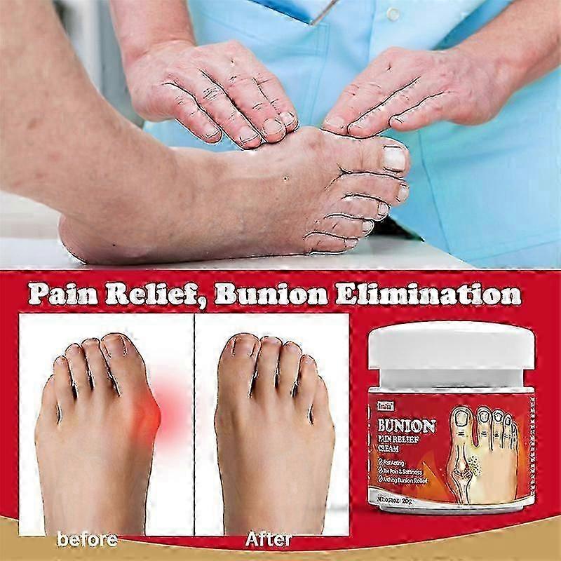 1-3x Bunion Smärtlindring Grädde Tå Led Valgus Corrector Cream Behandla Hallux Stelhet