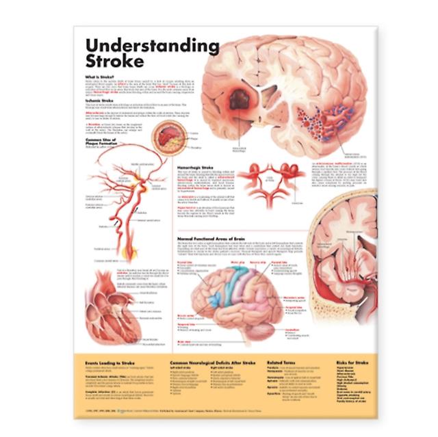 Understanding Stroke Anatomical Chart Wallchart Book