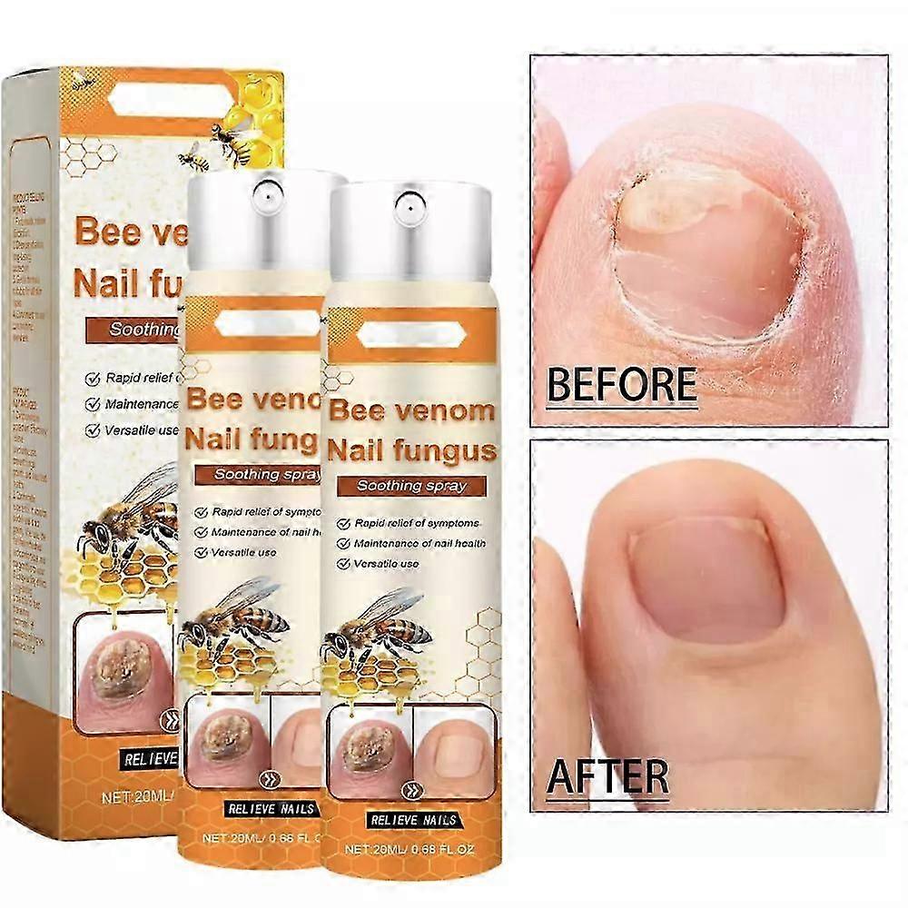 Bee Venom Nail Repair Solution for Ingrown Toenails