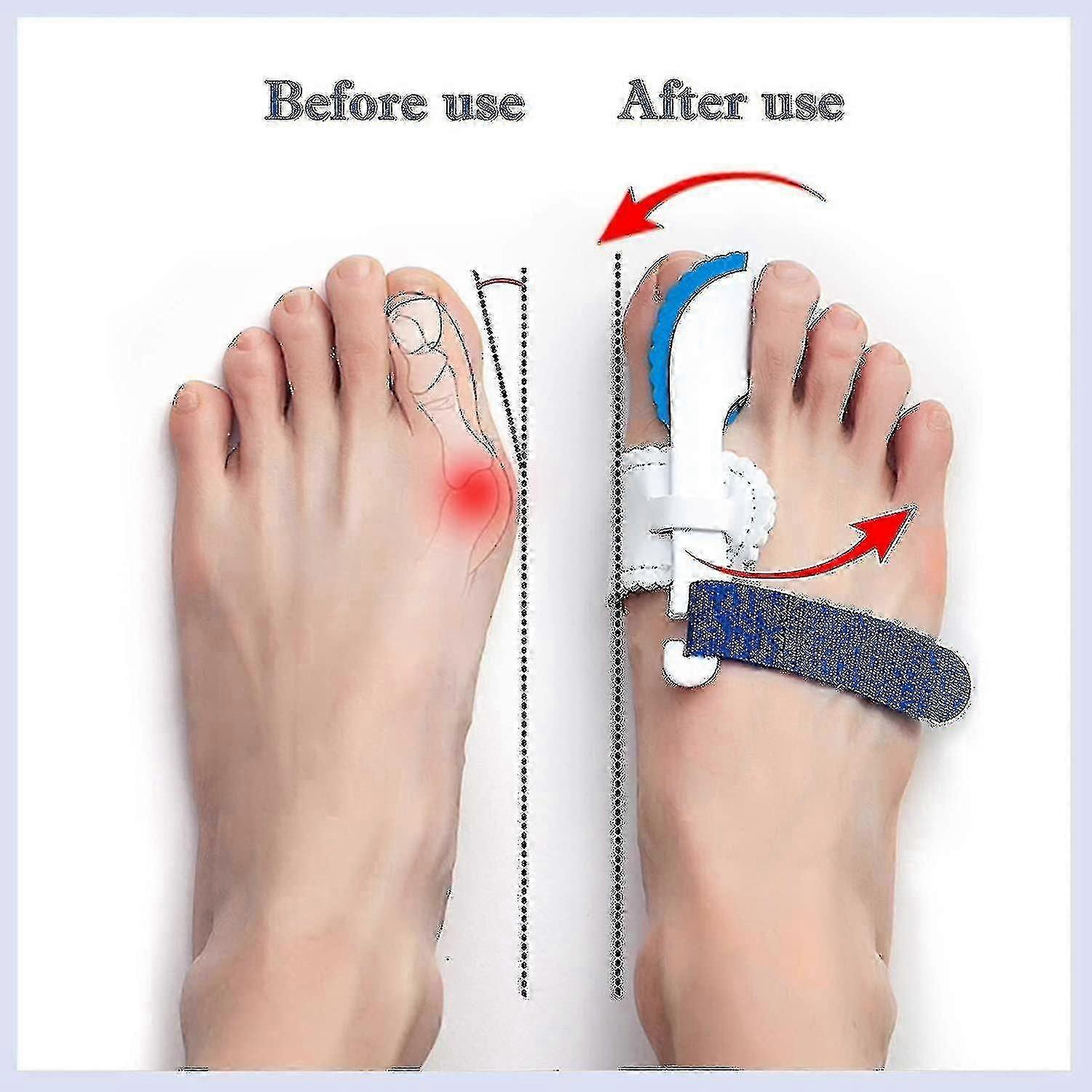 2pcs Orthopedic Bunion Corrector, Bunion Splint, Foot Pain Relief Hallux Toe Valgus Corrector Adjustable