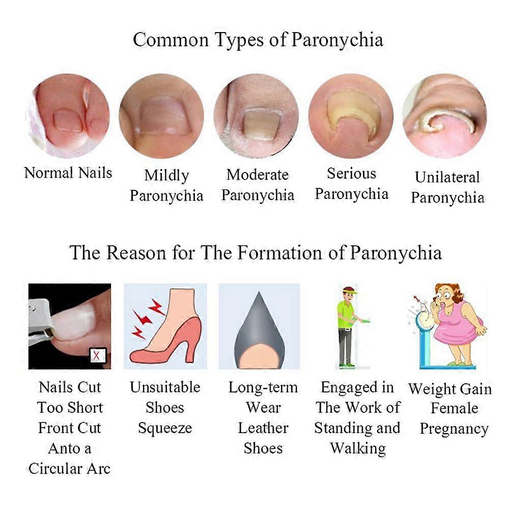 120Pcs Ingrown Toenail Straightening Clip Ingrown Toenail Correction Elastic Patches Paronychia Acronyx Correction Patch Foot Care Tool With Storage B
