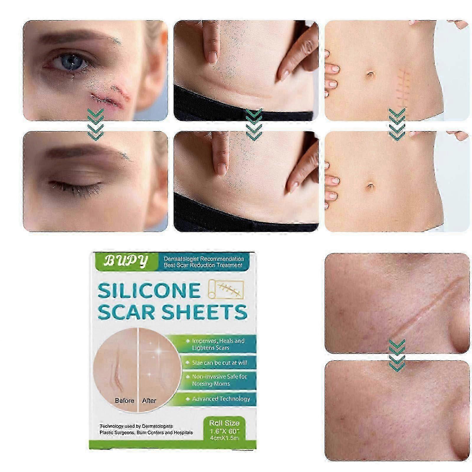 Ärrplåster, ärrtejprulle, ärrremsa, återanvändbar ärrborttagare för kejsarsnitt, keloid etc. 1,5 m lång