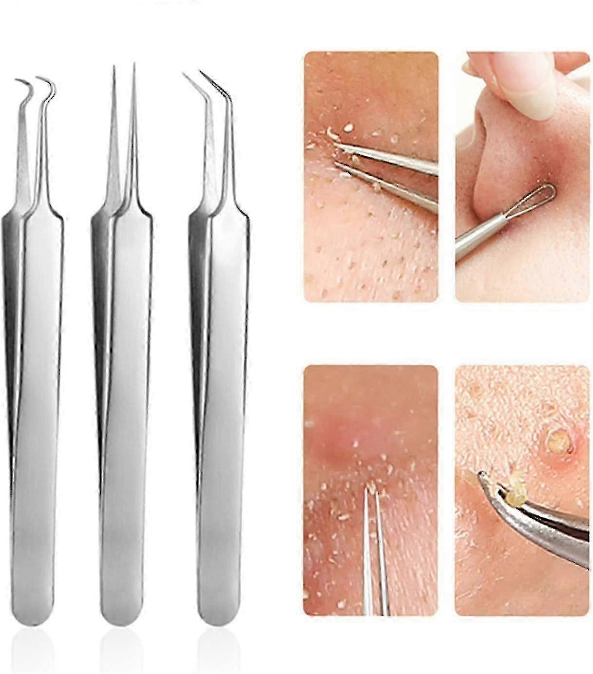 Stainless steel blackhead extractor set, 3-piece acne removal tools