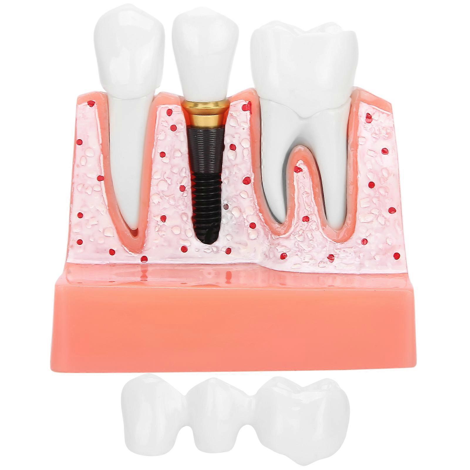 Teeth Model Dental Implant Analysis Crown Bridge Model Demonstration Tooth Model