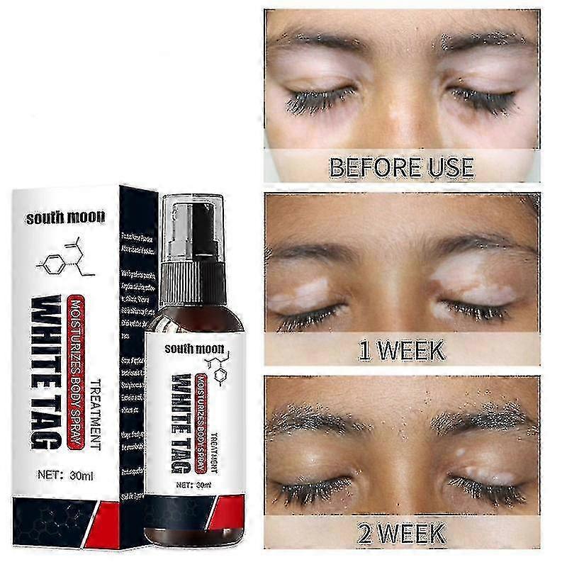 بخاخ البهاق ، علاج البهاق للبهاق الجلدي ، بخاخ العناية بالبهاق لتقليل البقع البيضاء