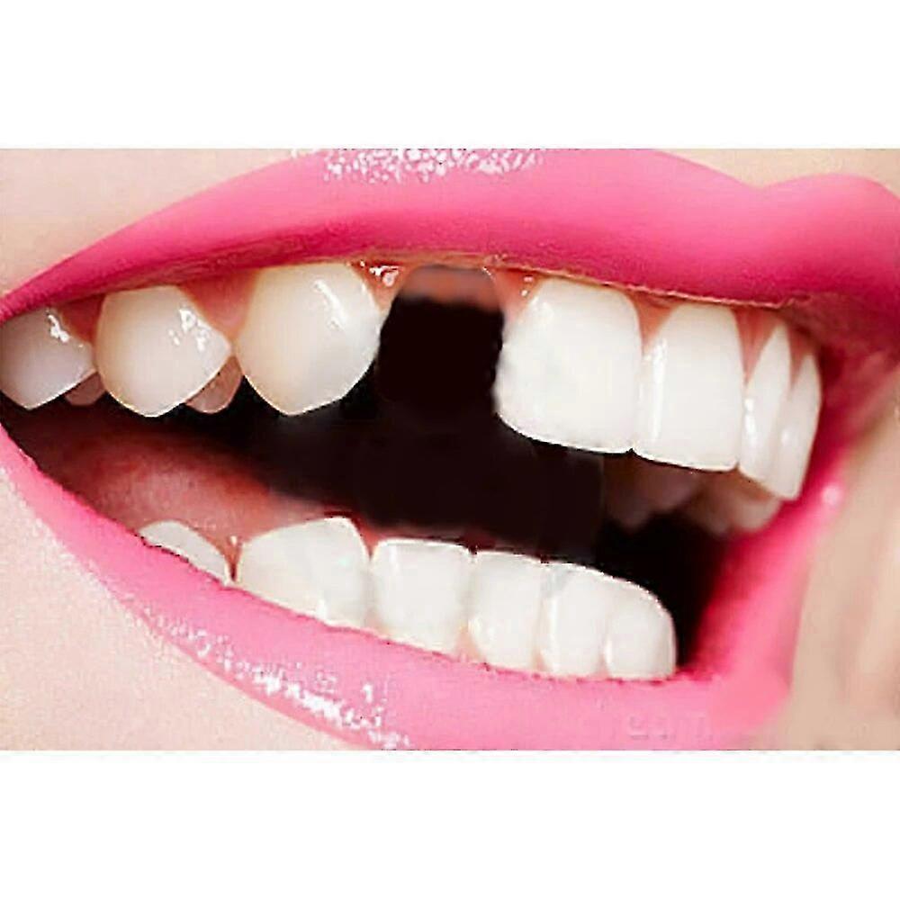 欠損した歯、隙間、虫歯を補うための一時的な歯科用充填材 - DIY 修理ツール