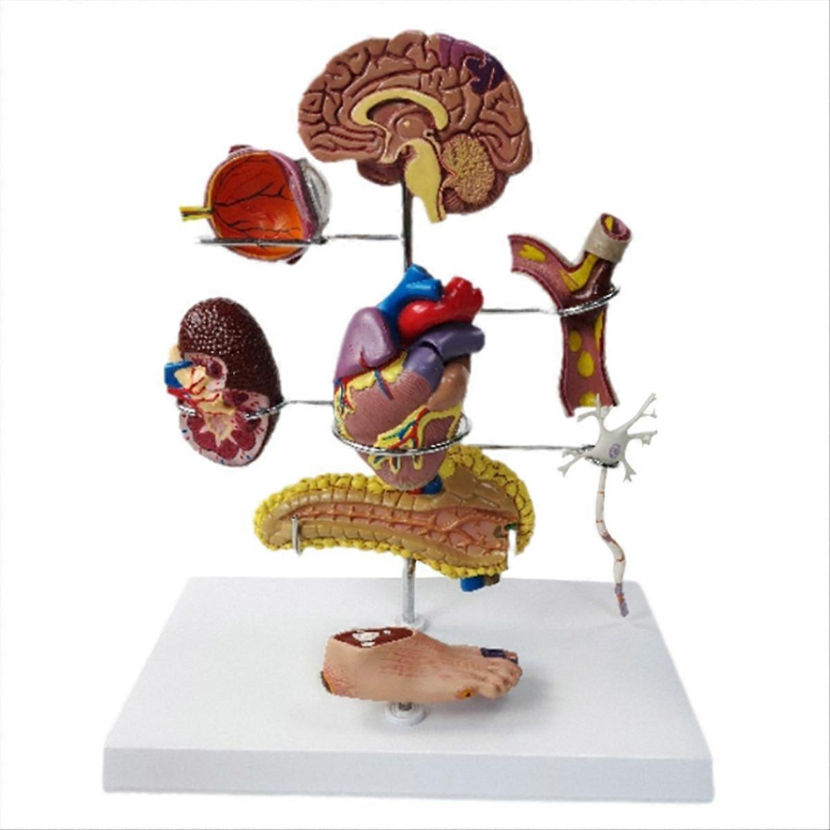 Type Ii Diabetes Model Set, For Human Anatomy And Physiology