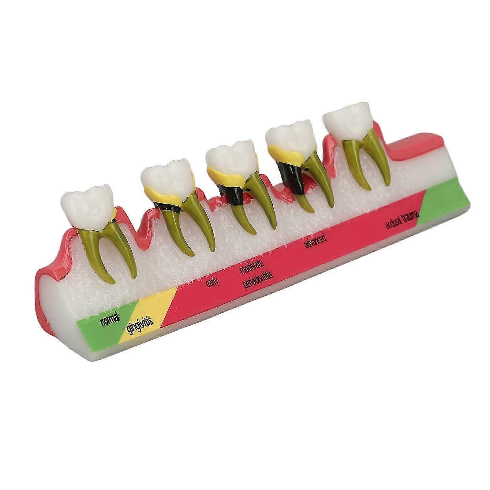 Teeth Periodontal Disease Model Different Stages Resin Dental Periodontitis Display Model