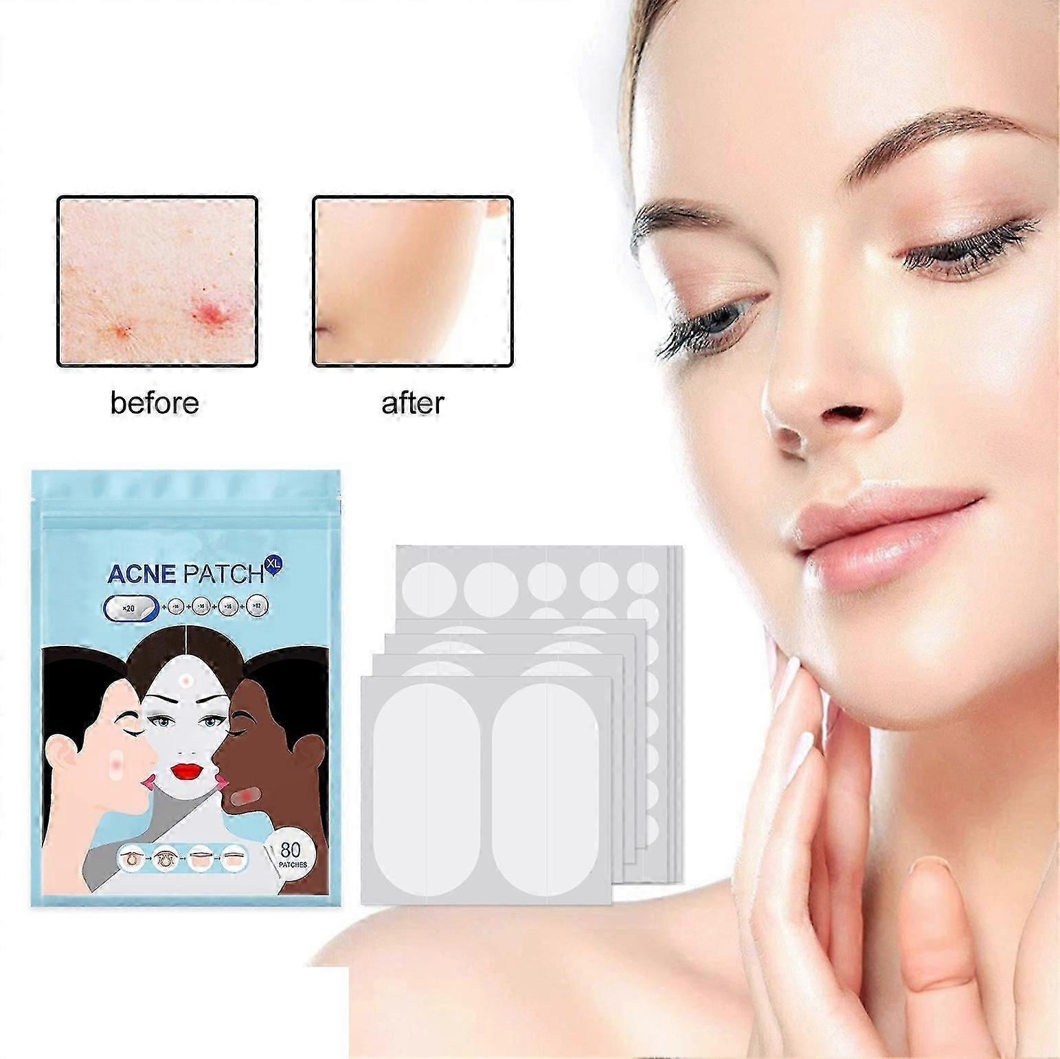 Acne Patches Large, Hydrocolloid Pimple Patches For Large Breakouts, Zit and Blemish, Large Acne Patches with Tea Tree Oil