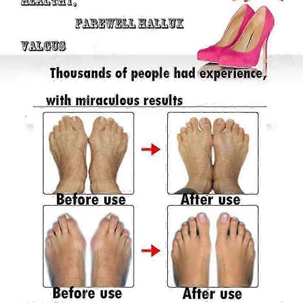thumb valgus corrector 2pcs compatible with bunion relief