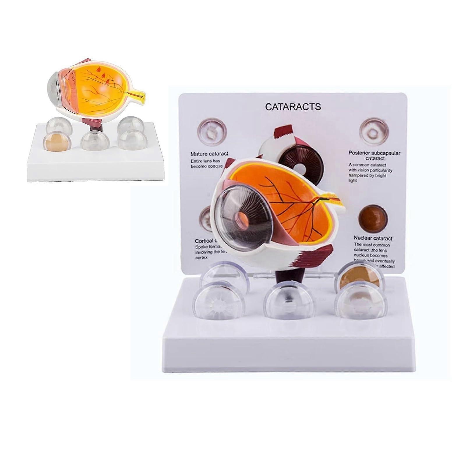 Cataract Eye Model with Interchangeable Lenses, Oversized Anatomical Eyeball for Medical Teaching