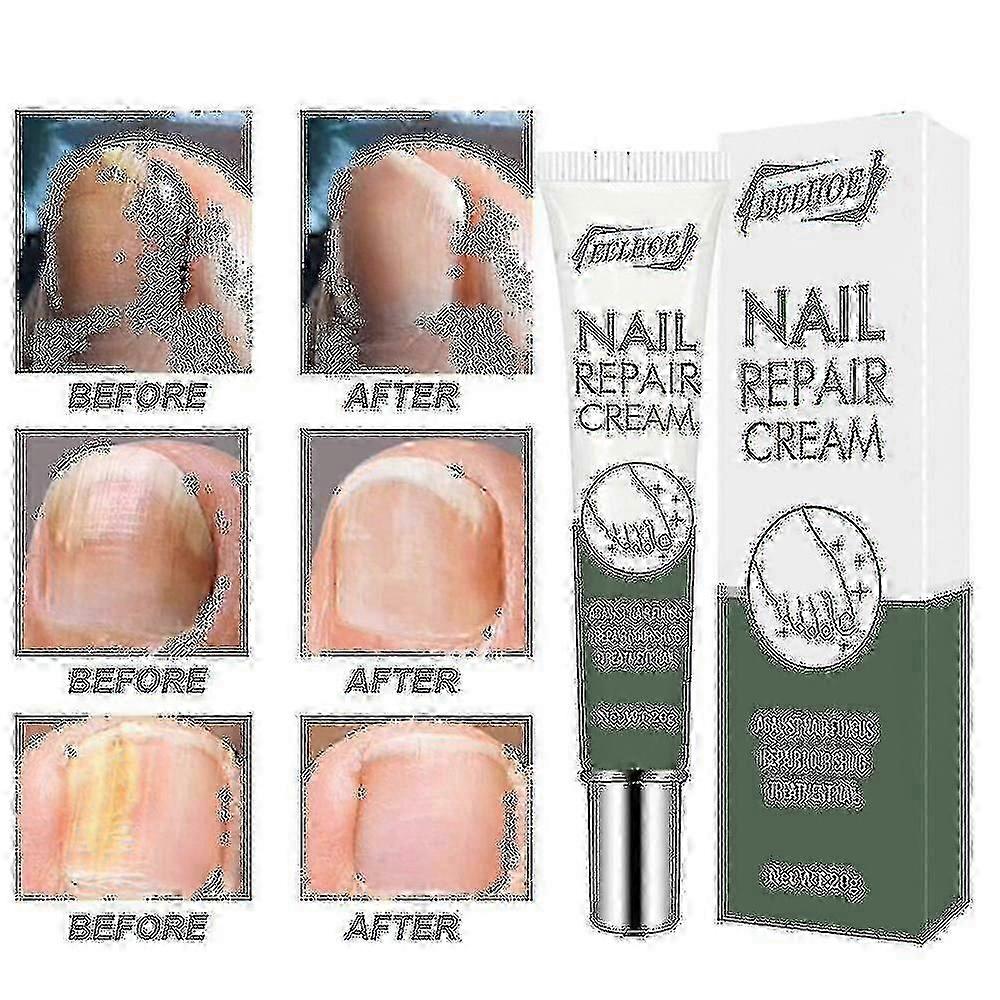 Onychomy Cream Quickly Remove Onychomycosis Manicure Na